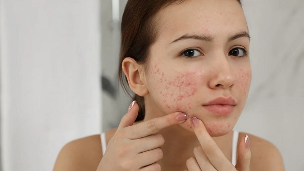 ăn hạt điều có nổi mụn không
